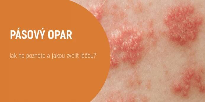 Pásový opar - jak ho poznáte - Tajemství zdraví