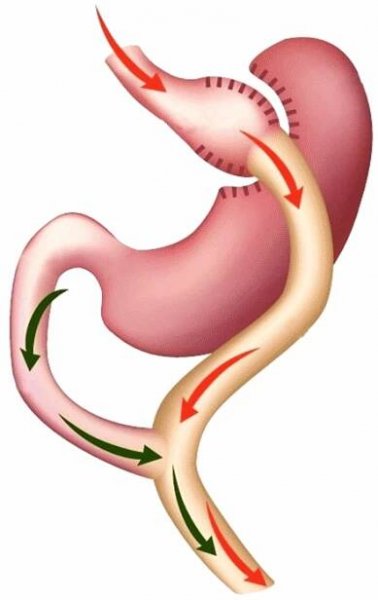 Žaludeční bypass (Roux-Y Gastric Bypass) pro obezitu, cukrovku 2. typu nebo metabolický syndrom - Ústřední vojenská nemocnice