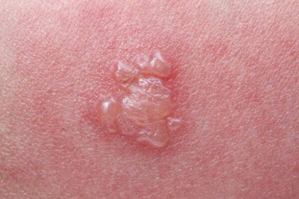 příznaky pásových oparů, zoster nebo herpes zoster na paži - ganglion - stock snímky, obrázky a fotky