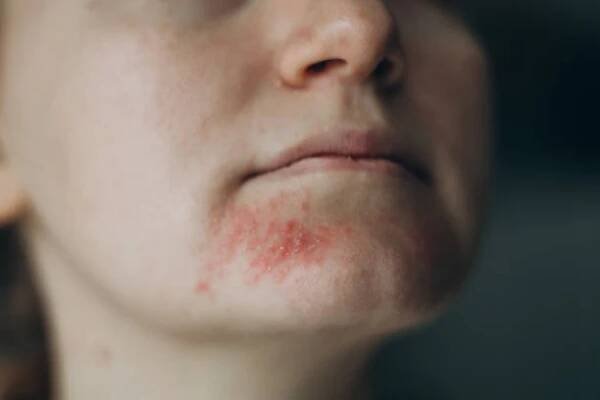 perioral dermatitis on woman face. closeup dermatitis on skin, ill allergic rash eczema skin of patient, atopic dermatitis symptom skin detail texture. the concept dermatology - seboroická dermatitida - stock snímky, obrázky a fotky