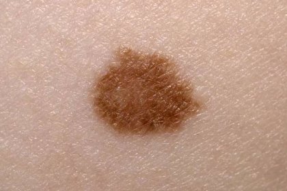 rakovina kože príznaky