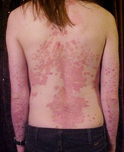 Psoriáza – Wikipedie
