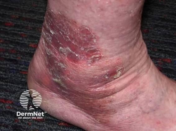 Chronic plaque psoriasis images — DermNet
