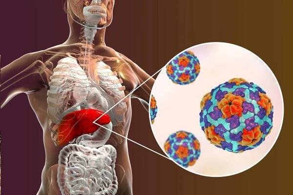 Hepatitída typu A (žltačka typu A) – ako sa prenáša a ako sa pred ňou chrániť? - TvojeZdravie.sk