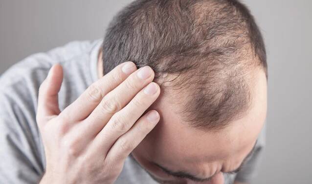 Male-Pattern Baldness: What Can You Do About It?