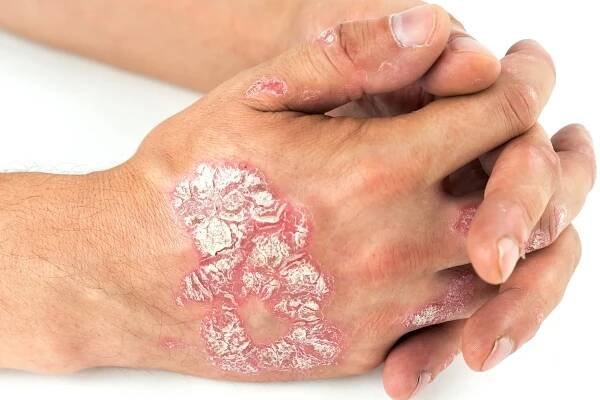 What Is Plaque Psoriasis?