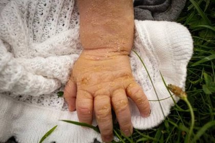 Trápení malého Marečka s vzácnou chorobou: Kůže plná prasklin a ranek potřebuje dvě hodiny péče denně!