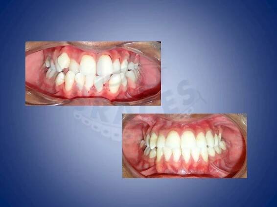Before and After – Braces In Mumbai Dr. Deep Garg for providing quality orthodontic treatment at various locations across