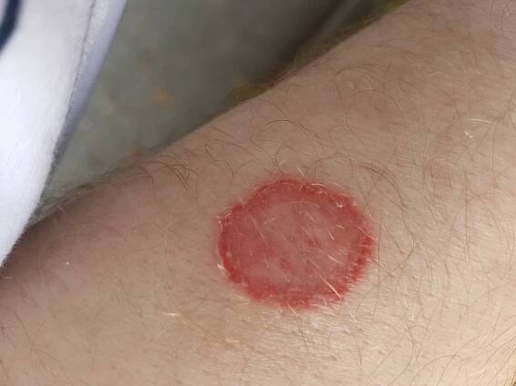 Dermatofytóza