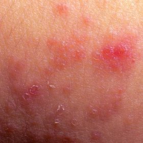 Ekzém atopická dermatitida symptom kůže detail textura — Stock obrázek
