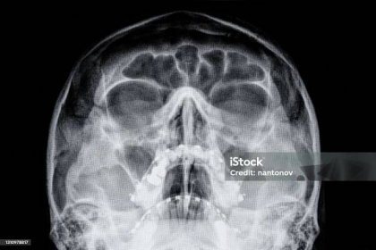 MAGNETICká rezonance MRI v lidském mozku a hlavě - Bez autorských poplatků Lékařský rentgen Stock fotka
