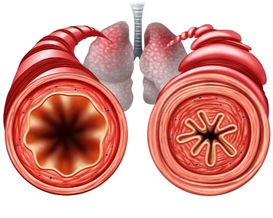 Asthma Attacks and Lung Damage