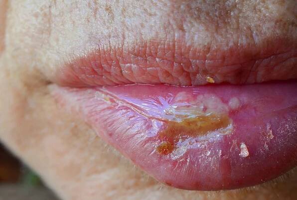 Oozing cold sore