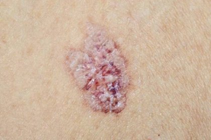Lichen sclerosus – příčiny, příznaky a léčba