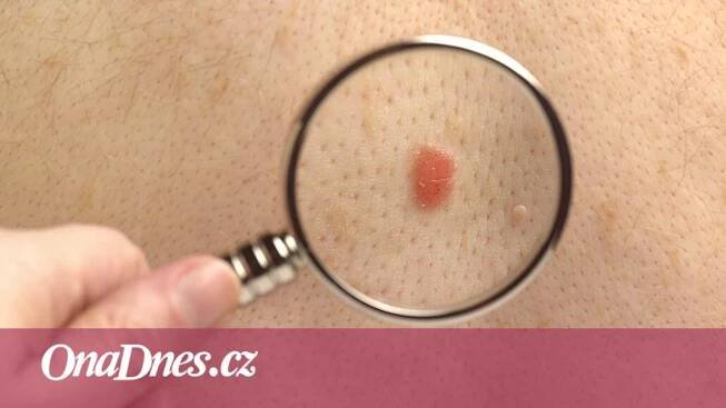 Nejčastější je bazaliom, nejagresivnější melanom. Jak poznat rakovinu kůže?