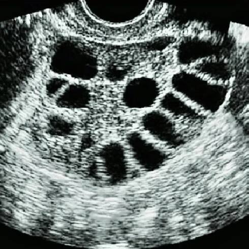 Syndrom polycystických ovarií | GYNORD plus