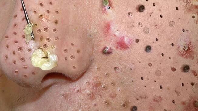 Blackhead Removal With Sac Dep Spa @100073951