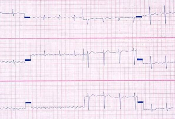 Low: Weird Heartbeat