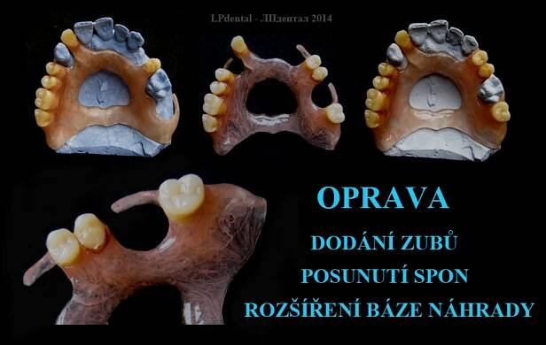 Bezkovové snímatelné náhrady z polyamidu-Deflex Classic | LPdental.cz