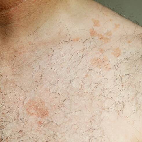 There's Fungus Among Us! - Siperstein Dermatology Group