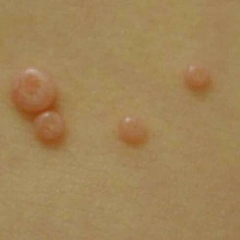 Molluscum Contagiosum - Pictures, Symptoms, Treatment, Causes
