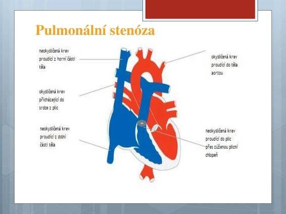 PPT - Vrozené vývojové vady srdce PowerPoint Presentation, free download - ID:6331357