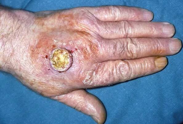 Picture of Keratoacanthoma (2 of 2)   