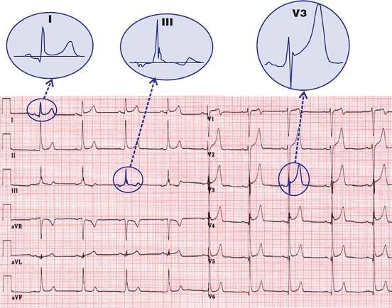 ECG benign early repolarisation, concave ST elvation, fish hook pattern, ST / T ratio