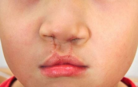 Chlapce ukazuje dvoustranného rozsedliny lip opraveno. — Stock fotografie