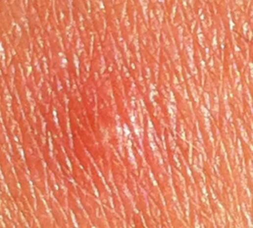 Adults - Molluscum Treat & Cure Guide