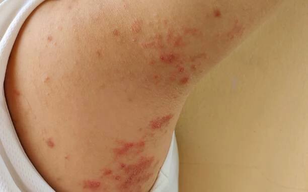 chronická dermatitida, alergie a vyrážka na těle. - impetigo - stock snímky, obrázky a fotky