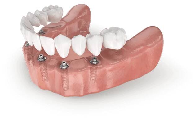 náhrada všech zubů pomocí implantátů