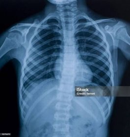 Rentgenový obraz hrudníku - Bez autorských poplatků Rentgenový snímek - Vědeckou zobrazovací techniku Stock fotka