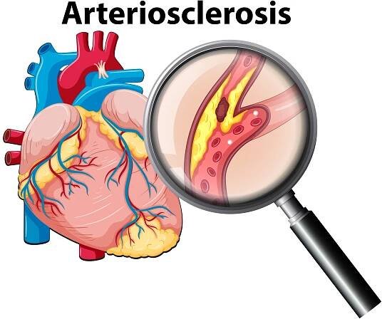 ateroskleróza