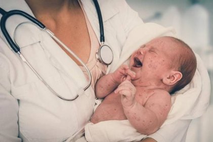 lékař drží novorozené dítě, které je nemocné zarděnky nebo spalničky - spalničky - stock snímky, obrázky a fotky