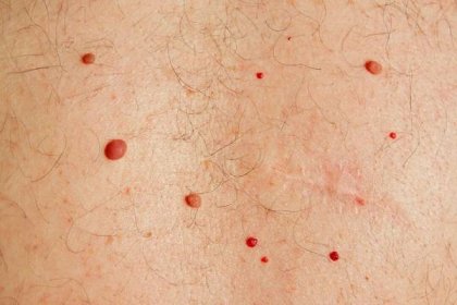 Papilomy na těle způsobené HPV