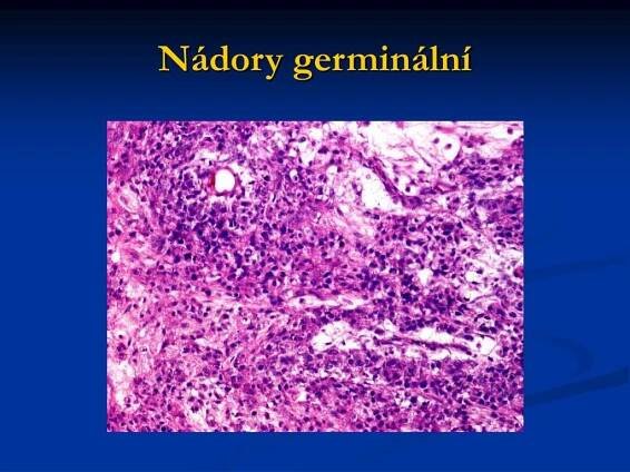 PPT - NÁDORY VARLAT A OVÁRIÍ PowerPoint Presentation, free download - ID:4598887