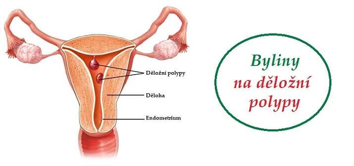 Polypy dělohy - byliny, bylinky, léčivé rostliny, léčba bez operace a léků - Bylinky pro všechny
