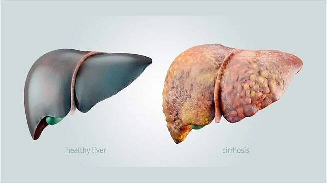 The Stages of Liver Disease - American Liver Foundation