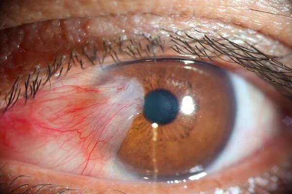 37-facts-about-pterygium