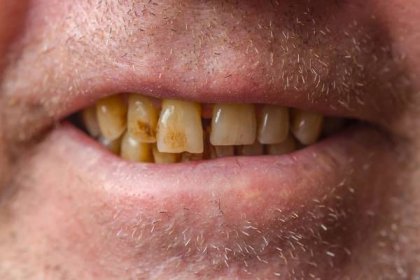 Špatná zubní hygiena způsobuje rakovinu, varují lékaři. Naučte se patogenů v ústech zbavit - AAzdraví.cz