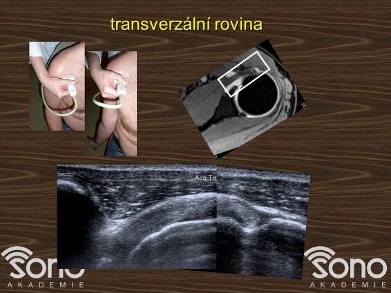 UZ ramena 1: anatomie, metodika (MUDr. Brtková) | Sonoakademie
