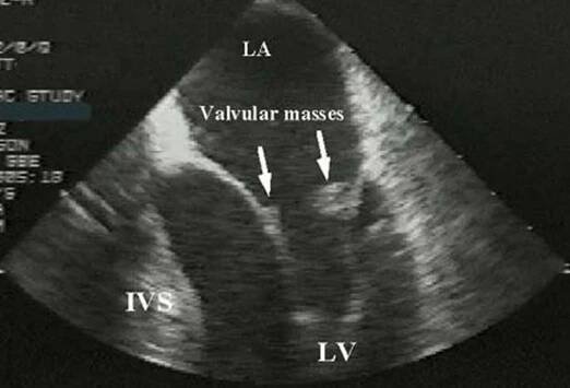 Systémový lupus erythematosus (SLE)
