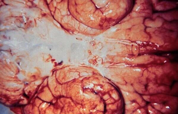 Hemofilová meningitida – WikiSkripta