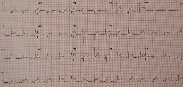 PericarditisMyocarditis