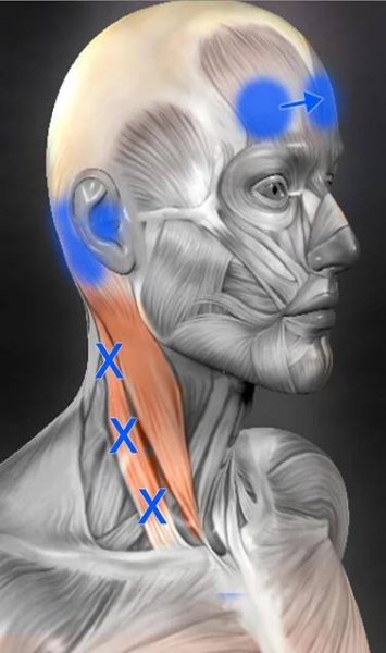 CEFALEAS Y SU RELACIÓN CON LA MUSCULATURA DEL CUELLO Y CABEZA - Nacho Varela