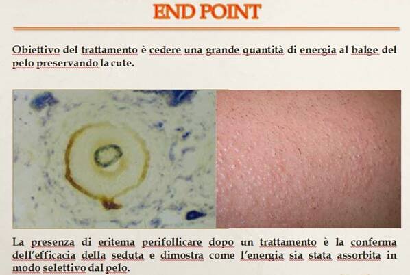 epilazione78