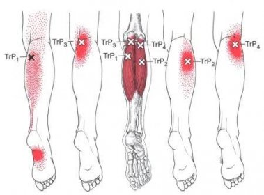 Bolest plosky nohy - příčiny - Spoušťovýbod