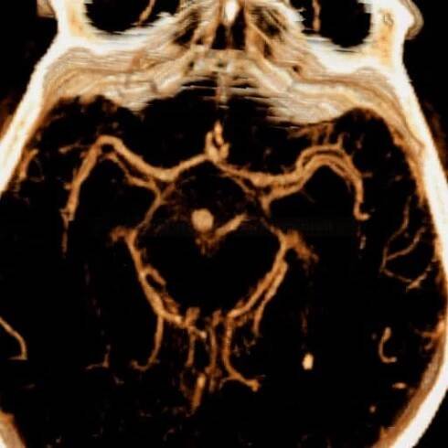 CT angiografie - subarachnoidální krvácení v důsledku ruptury aneuryzmatu na vrcholu a.basilaris