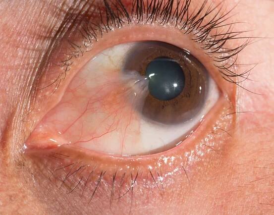 Pterygium New York City